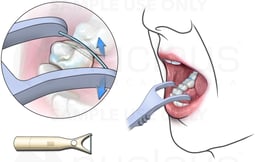 Using a Flossing Tool