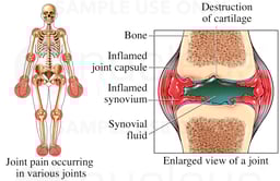 Rheumatoid Arthritis