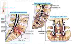 L5-S1 Spondylolisthesis with Subsequent Surgical Fusion