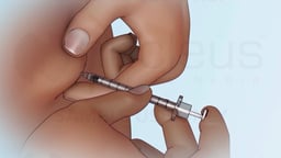 Cómo inyectarse insulina con una jeringa
