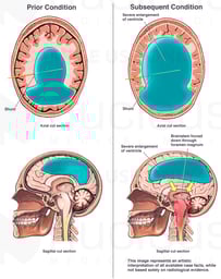 Shunt Obstruction with Fatal Hydrocephalus