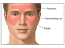 Sinus Headache: Areas of Pain