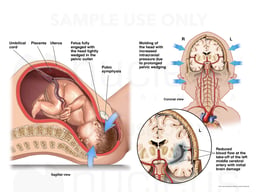 Increased Intracranial Pressure with Decreased Bloodflow to the Brain