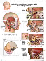 Radical Temporal Bone Resection with Muscle Flap Closure