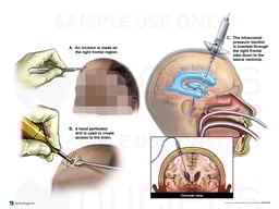 Surgical Placement of Right Ventriculostomy and Pressure Monitor