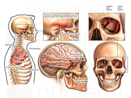 Lateral Male Torso with Brain Injury and Fractures to the Cranium, and Left Orbit