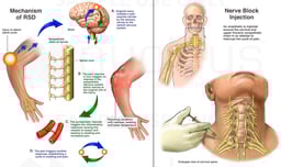 Post-surgical Reflex Sympathetic Dystrophy (RSD) of the Upper Extremity with Nerve Block Injection