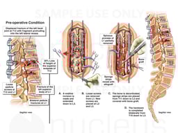 Second Spine Surgery: Surgical Decompression and Stabilization of Failed Fusion Hardware