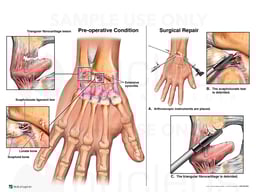 Right Wrist Injuries with Initial Surgical Repair