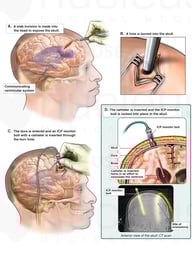 Surgical Placement of Right Frontal Ventriculostomy Intracranial Pressure Monitor