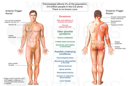 Fibromyalgia Syndrome (Male)