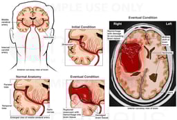 Rupture of Cerebral Aneurysm