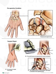 Right Wrist Injuries with Second Surgical Repair