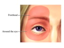 Glaucoma: Areas of Pain