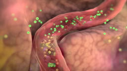 Polycystic Ovary Syndrome (PCOS)