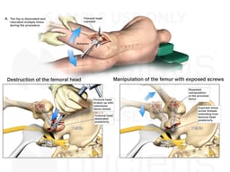 Alternate Causes of Sciatic Nerve Injury