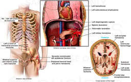 Injuries to the Ribs, Hip, Brain, Spleen and Lungs from Auto Accident