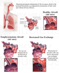 Emphysema, COPD