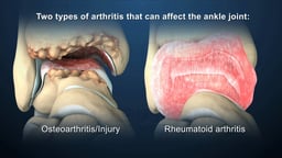 Osteoarthritis vs. Rheumatoid Arthritis in the Ankle Joint