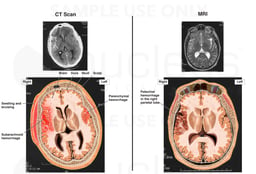 Traumatic Brain Injury