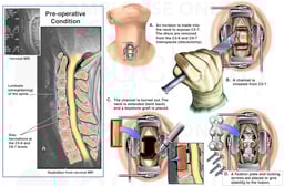 Cervical Spine Injuries with Proposed Corpectomy, Strut Graft and Spinal Fusion Surgery