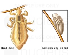 Head Lice