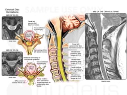 Cervical Spine Injuries