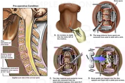 Spinal Surgery - C5-6 and C6-7 Disc Herniations with Surgical Discectomy (Diskectomy)