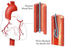 Heart Attack (Myocardial Infarction) Due to Blood Clots