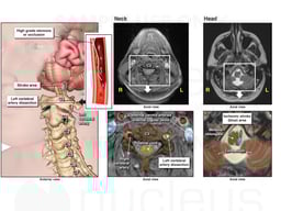 Vertebral Artery Dissection / Stroke