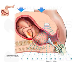 Vacuum Assisted Delivery with Resulting Shoulder Dystocia and Brachial Plexus Injury