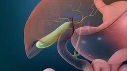 Open Cholecystectomy (Gallbladder Removal)