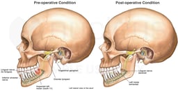 Impacted Third Molar Damaging Lingual and Inferior Alveolar Nerves