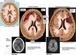 Intracranial Hemorrhage and Cerebral Infarct