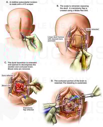 Surgical Craniotomy and Evacuation of Cerebellar Contusion

