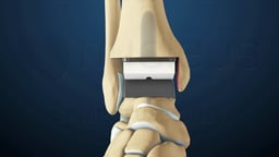 Anterior View of Ankle Replacement with Prosthetic Components