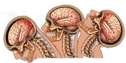 Whiplash - Closed Head Injury with Brain