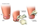 Incision and Drainage of Abscess
