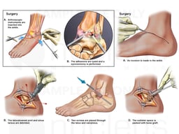 Left Ankle and Foot Injuries and Surgeries