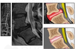 Lumbar Spine Injury