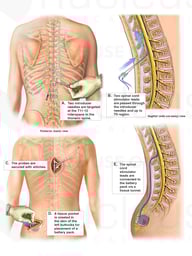 Insertion of Spinal Cord Stimulator