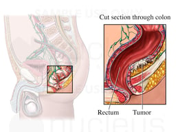 Rectosigmoid Colon with Colon Cancer