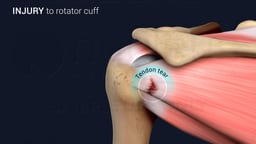 Rotator Cuff Tendon Tear in Shoulder Joint