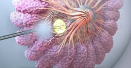 What is Radiation Therapy for Breast Cancer? 