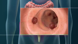 Understanding Colorectal Cancer