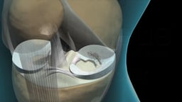 Knee Arthroscopy (condensed)