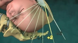 Birth Stations of Presentation: 1/3 System (Lateral View)