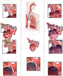 COPD: Chronic Obstructive Pulmonary Disease