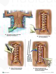Bilateral Posterior Fusion T10-L3
