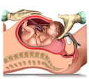 Cesarean Delivery, Lateral Cut-away View